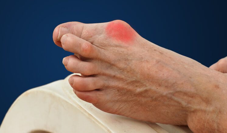 Bunion Pain